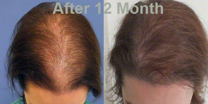 pills to help regrow hair